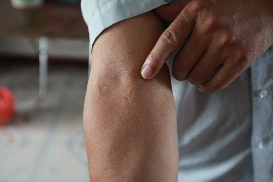 由于献血次数太多,孙爱兵胳膊上的针眼清晰可见.